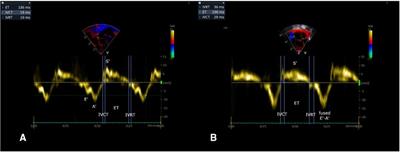 Diastolic ventricular function in persistent pulmonary hypertension of the newborn